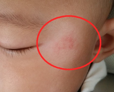 生後4ヵ月 赤ちゃんが顔 目の横 を引っ掻いてかぶれた体験談 Mamimua マミームア